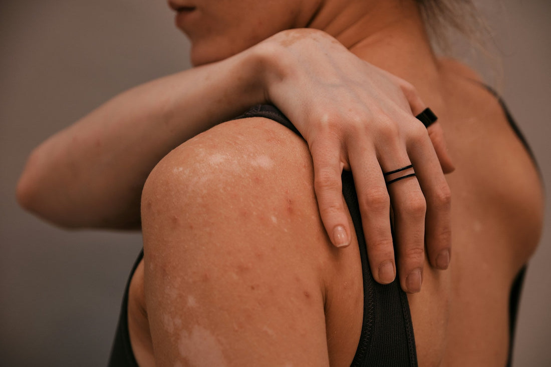 Skin Series: About Psoriasis