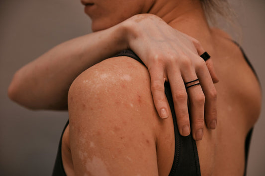 Skin Series: About Psoriasis