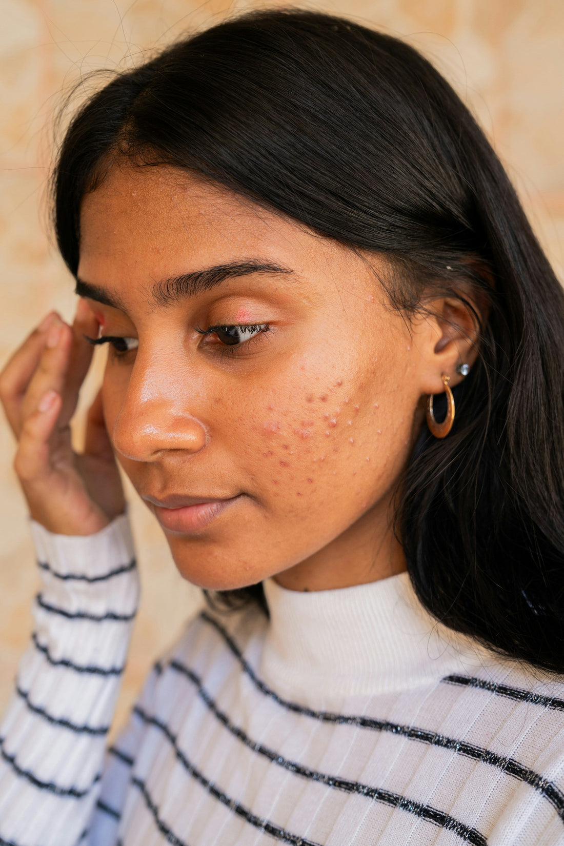 The Lifecycle of a Pimple