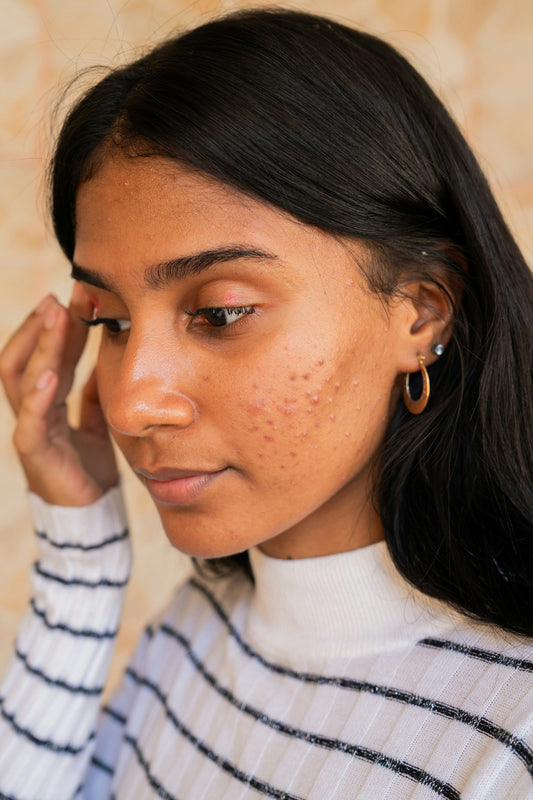 The Lifecycle of a Pimple