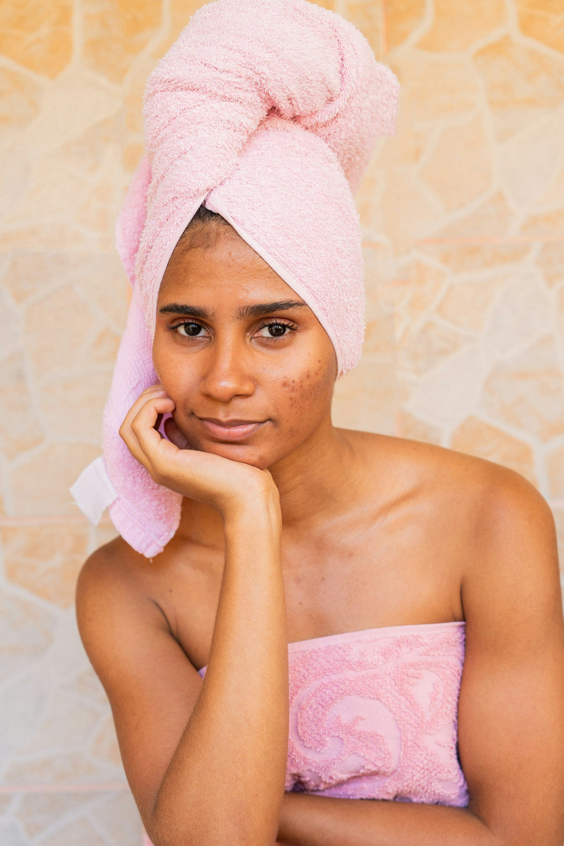 Adult vs Teenage Acne