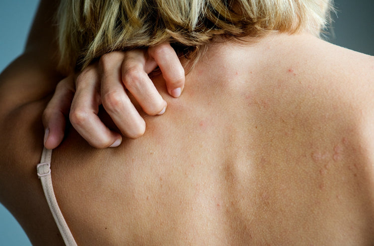 Psoriasis Recommendations